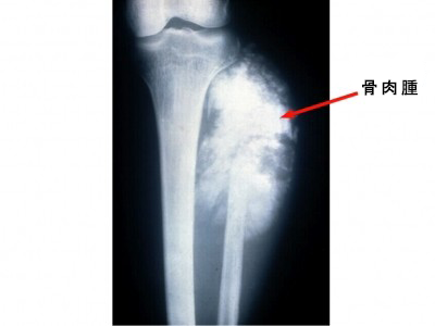 脛骨 腓骨に出来た骨肉腫のctデータから3d造形 ジャンボ百花繚乱