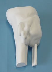 脛骨・腓骨・骨肉腫・３Ｄ造形